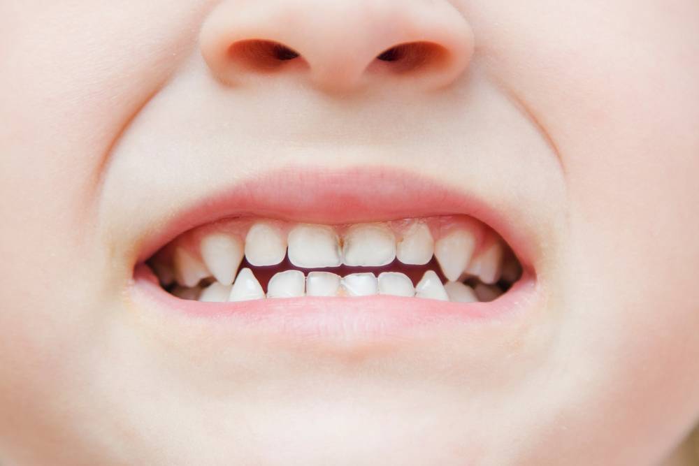 Diversas manchas en los dientes de bebés y niños: posibles causas y consejos para su tratamiento
